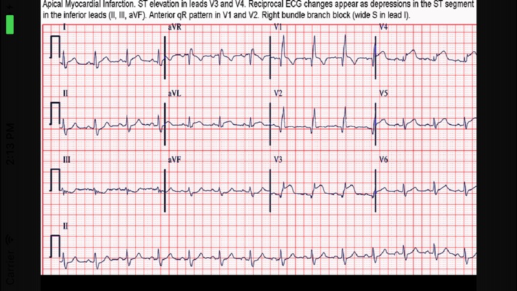 ECG Interpreter