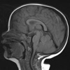 Myelination Brain
