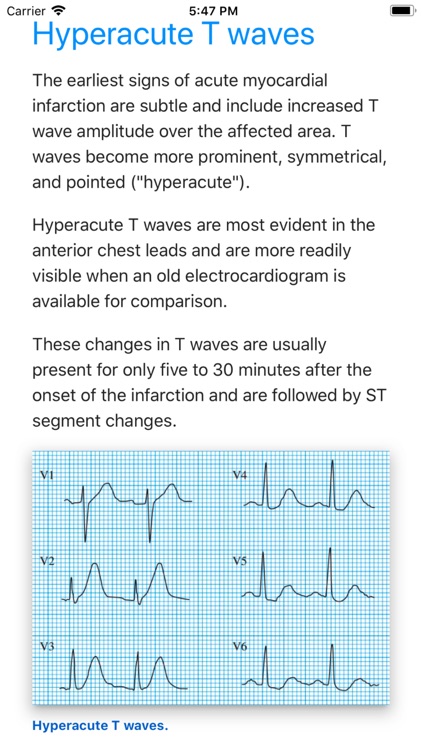 ECG Basics Lite: ECG Made Easy screenshot-3