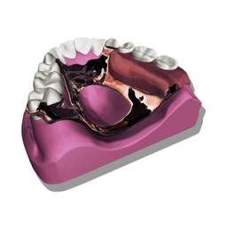 Removable Partial Dentures