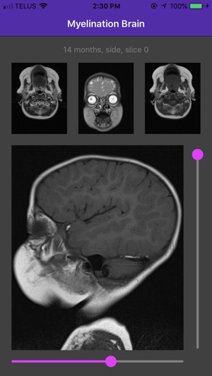 Myelination Brain(圖3)-速報App