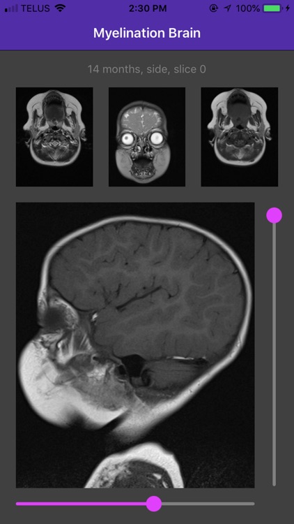 Myelination Brain