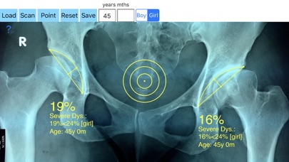 AcetabularDepthRatioApp screenshot 4