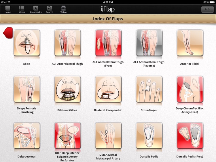 iFlap: Reconstructive Flaps