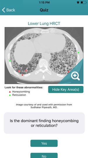 Rad Rounds UIP to IPF(圖3)-速報App