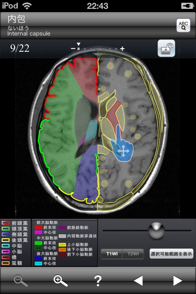 断面図ウォーカー脳MRI screenshot 2