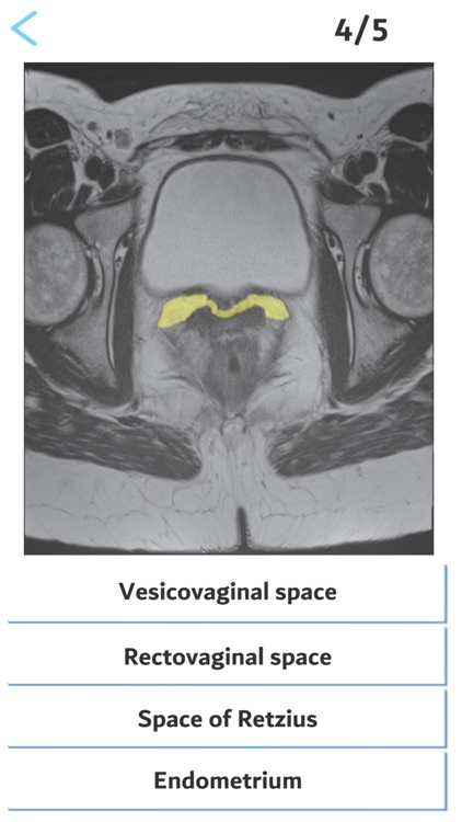 Female pelvis MRI RSNA screenshot-4