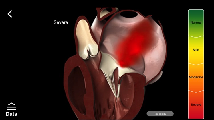 Mitral & Tricuspid Valves screenshot-3