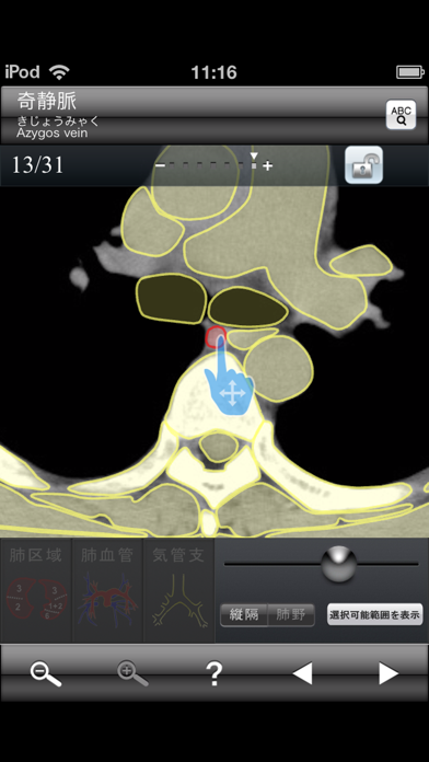 断面図ウォーカー胸部CT screenshot1