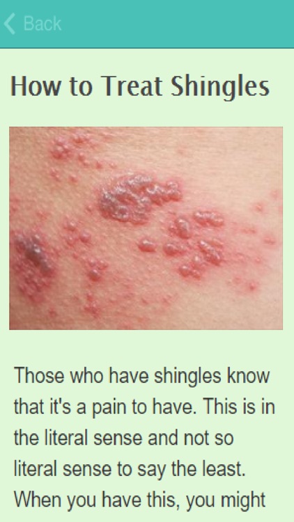 How To Treat Shingles By Gary O Brien