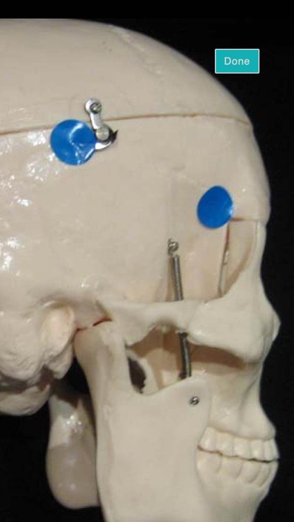 Craniotomy screenshot-4