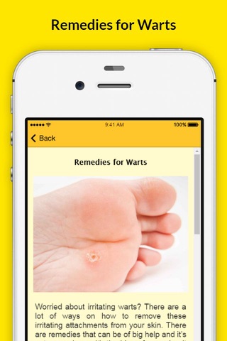 Mole Removal Remedies - Genital Wart Treatments screenshot 2