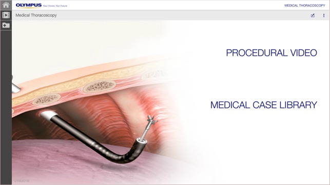 MedThora - Medical Thoracoscopy Under Lo