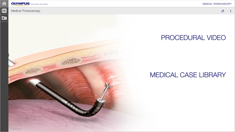 MedThora - Medical Thoracoscopy Under Local Anaesthesia