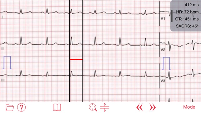 Photo EKG(圖1)-速報App