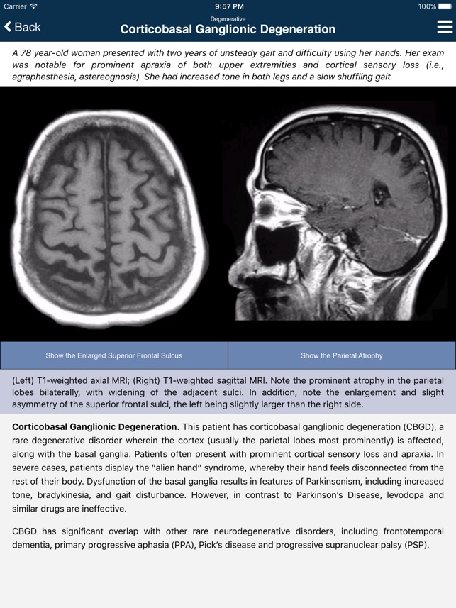 Nina Neuroimaging in Neurology(圖5)-速報App