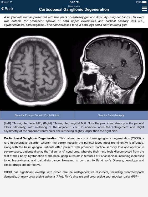 Nina Neuroimaging in Neurology screenshot-4