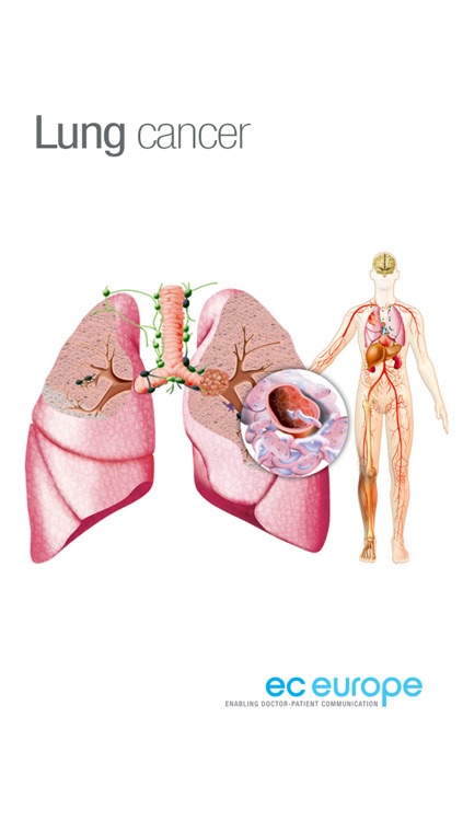 Miniatlas Lung Cancer