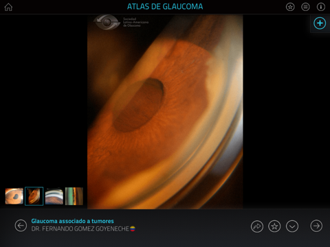 Atlas de Glaucoma screenshot 4