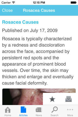 Rosacea by AZoMedical screenshot 3