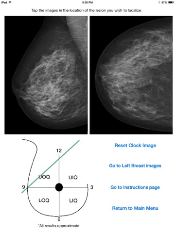 Mammography Localizer screenshot 2