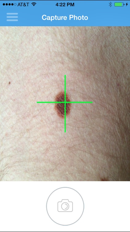 Lubax - Skin lesion ID using image recognition