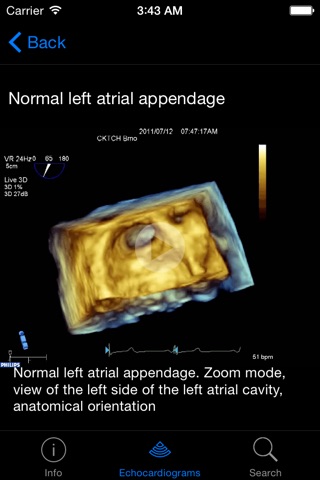 CARDIO3® 3D Echocardiography screenshot 3