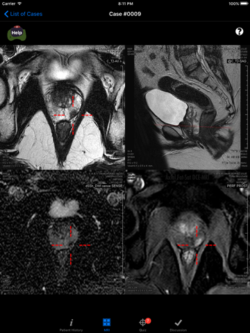 Prostate Cancer Imaging LITE screenshot 3