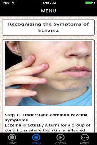 How To Treat Your Eczema - Best Way To Handle Your Eczema (Body, Face, Hand, Baby, etc.) For Beginners screenshot 2