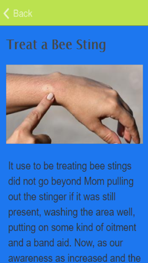 How To Treat A Wasp Sting