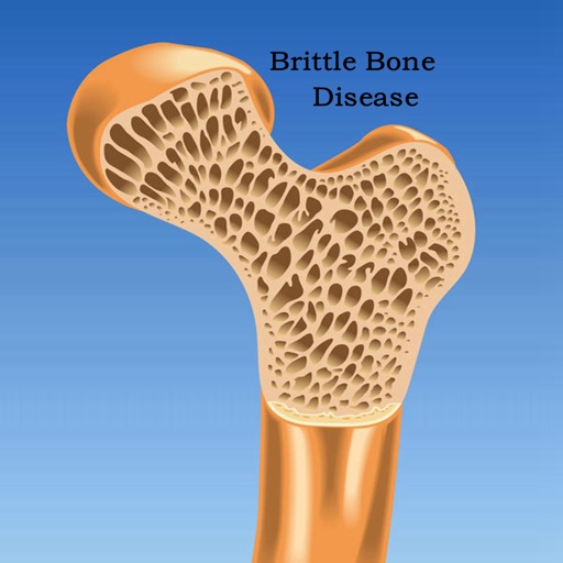 Brittle Bone Disease 101:Research,Symptoms and Treatment icon