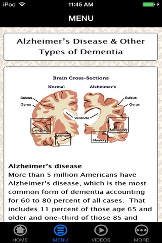 How to Avoid, Find & Cope with Alzheimer's Disease for Beginners to Experience - Understanding Alzheimer's Right screenshot 4