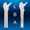 Revision femoral prosthesis