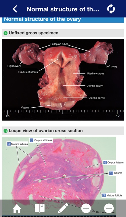 ATLAS OF PATHOLOGY And Comparison With Normal Anatomy