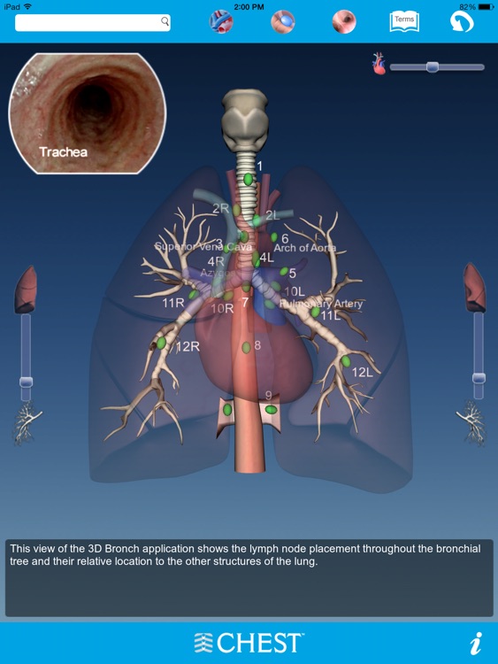3D Bronch screenshot-3