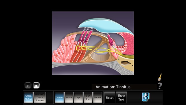 Ear Disorders: Inner