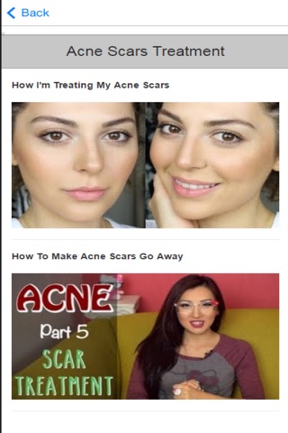 Acne Treatment - Learn How to Treat Acne Fast and Naturally screenshot 4