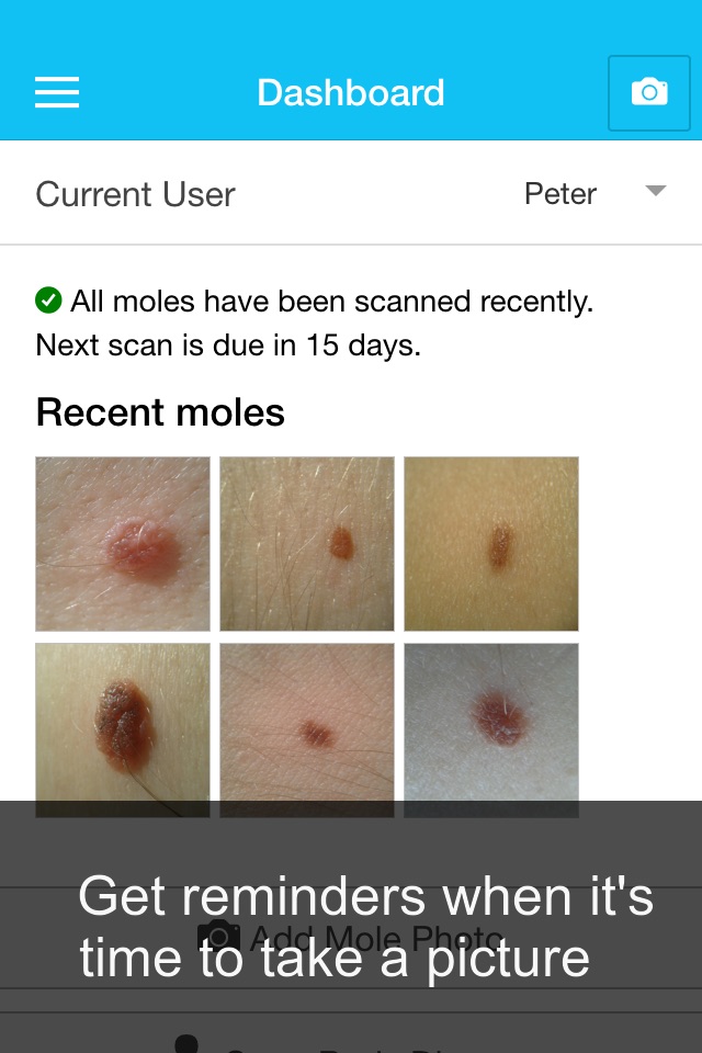 Skin Cancer App - MySkinPal - Map your skin moles screenshot 4