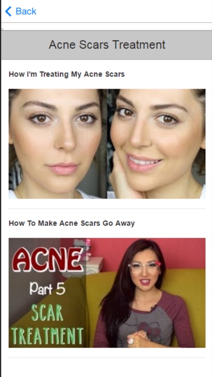 Acne Treatment - Learn How to Treat Acne Fast and Naturally screenshot-3