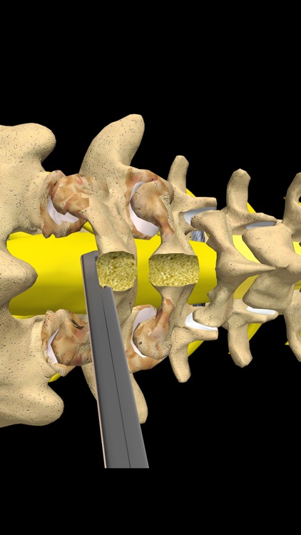 mLumbarLaminectomy