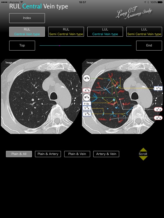 Lung CT Anatomy STUDY