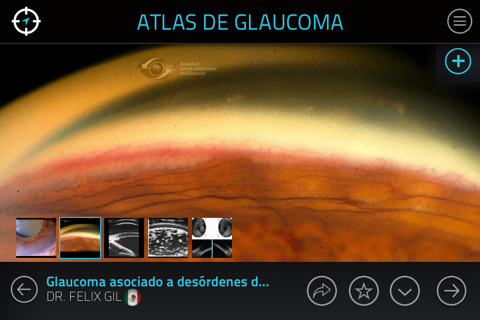 Atlas de Glaucoma para iPhone screenshot 3