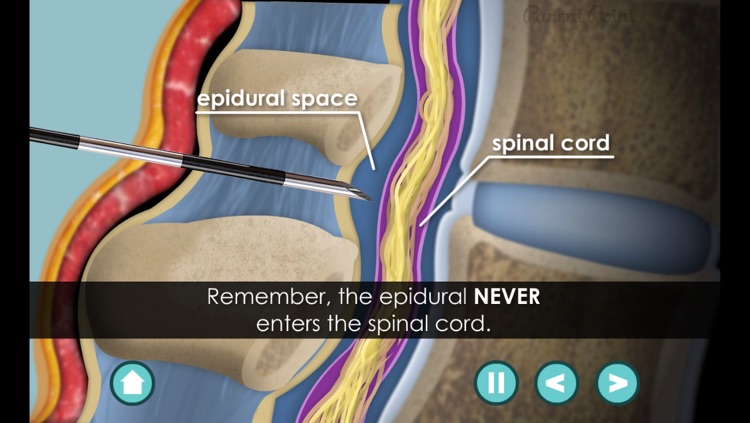 Child Birth with Epidural