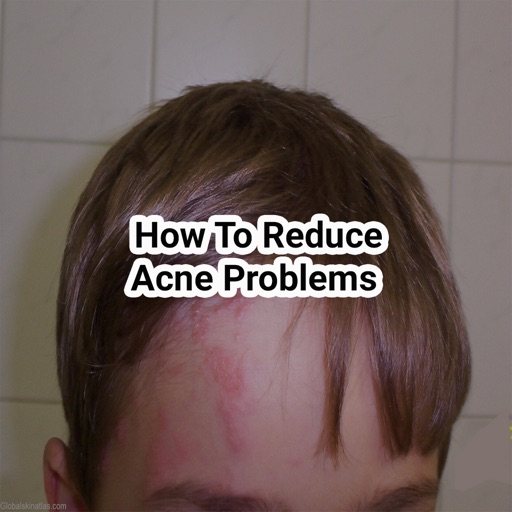 How to reduce acne problems icon