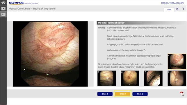 MedThora - Medical Thoracoscopy Under Local Anaesthesia(圖5)-速報App