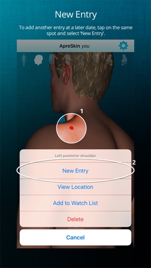 ApreSkin you - track your moles, skin cancers / melanoma and(圖3)-速報App