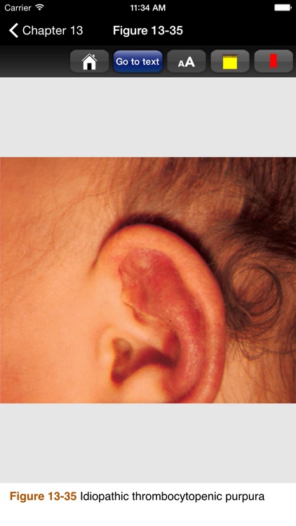 Color Atlas of Pediatric Dermatology screenshot-3