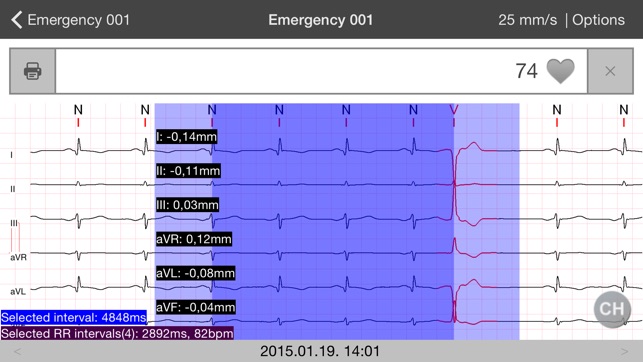 Cardiospy Mobile ECG(圖4)-速報App