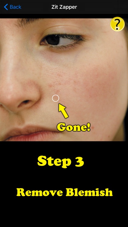 Zit Zapper Pro - Acne Remover screenshot-3