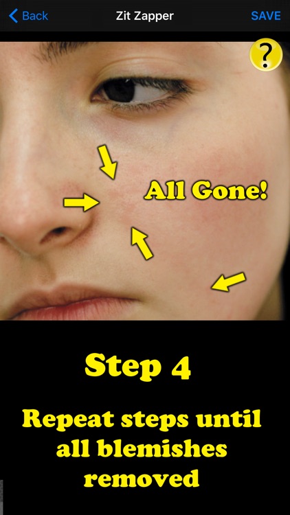 Zit Zapper Pro - Acne Remover screenshot-4
